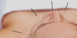 Read more about the article Tips for DIY Acupuncture